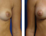 breast augmentation before and after