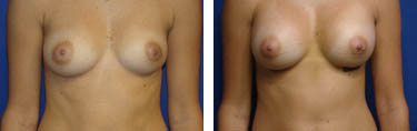 breast augmentation before and after