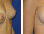 breast augmentation before and after
