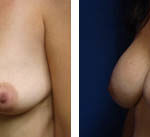 breast augmentation before and after