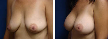 breast augmentation before and after