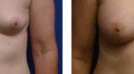 breast augmentation before and after