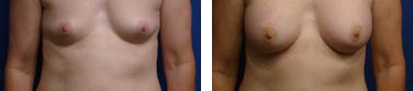 breast augmentation before and after