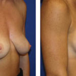 breast augmentation before and after