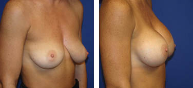breast augmentation before and after