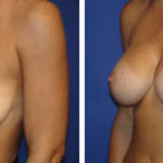 Breast Augmentation - Before and After