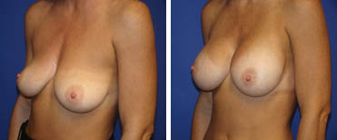 Breast Augmentation - Before and After
